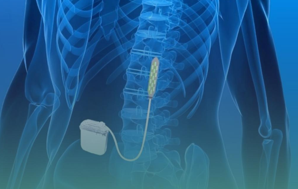 Neuroestimulação medular e eletrodo na medula para dor crônica